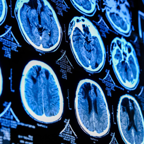 Studiu arată că pandemia și stresul asociat au accelerat îmbătrânirea creierului chiar și la persoanele neinfectate cu COVID-19