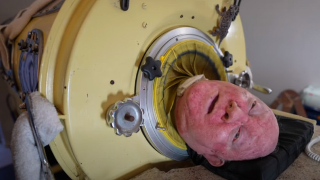 Paul Alexander, cunoscut sub numele de „Polio Paul”, a murit la vârsta de 78 de ani din cauza bolii poliomielitei. A trăit timp de 70 de ani într-un „plămân de fier” și a fost declarat cel mai longeviv pacient din istorie care a trăit în aceste condiții.